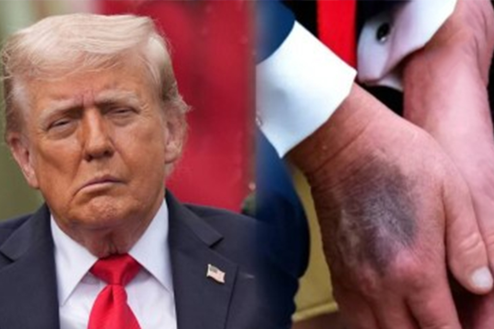 हातावरील निळ्या जखमांमुळे चर्चेत ट्रम्प; तब्येतीवर स्वतः दिले स्पष्टीकरण 